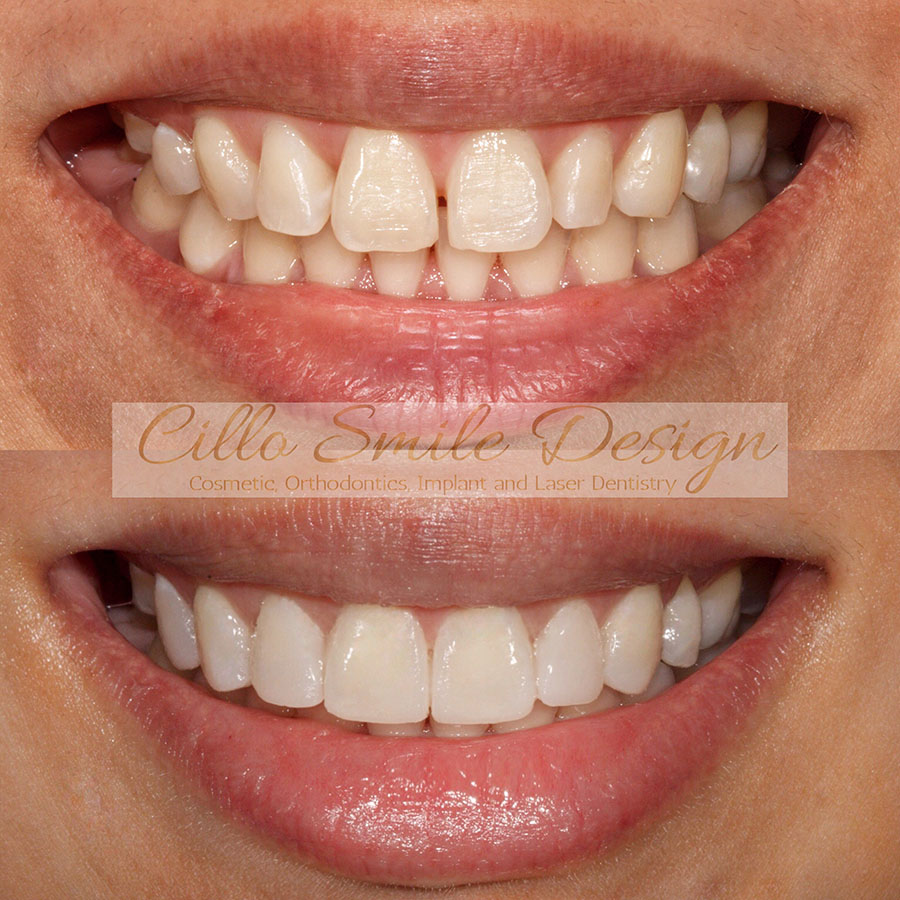 before and after teeth picture - Cillo Smile Design
