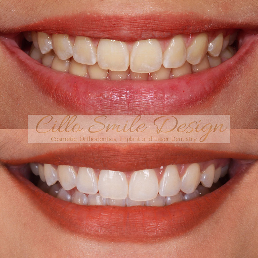 before and after teeth picture - Cillo Smile Design