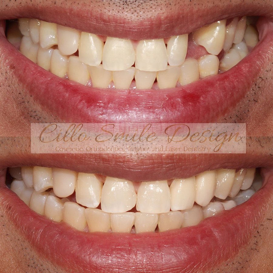 before and after teeth picture - Cillo Smile Design