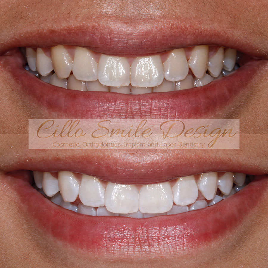 before and after teeth picture - Cillo Smile Design